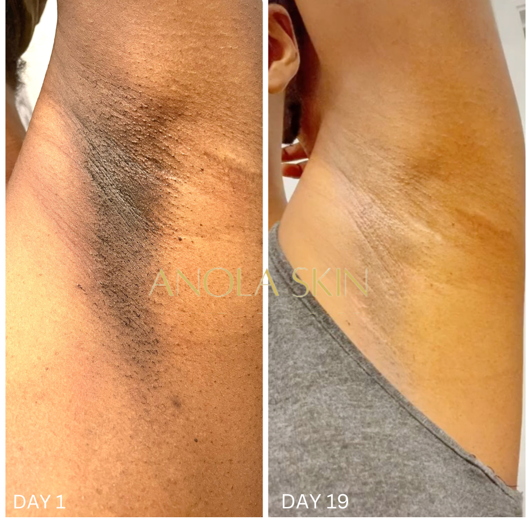 Intense Discoloration Treatment (Rapid Action)